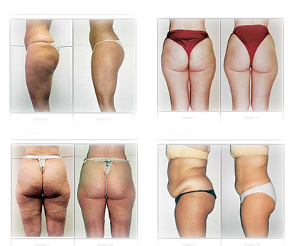 Endermologie Endermologie