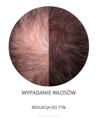 Wypadanie włosów